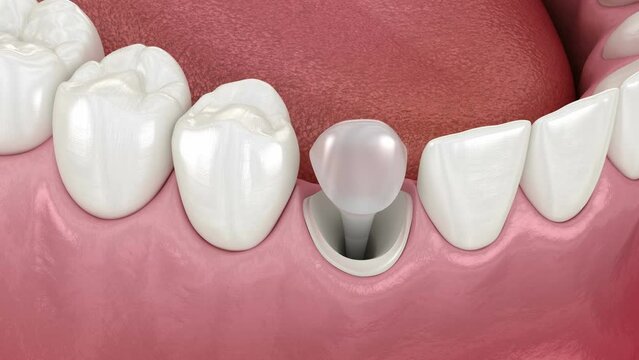 Dental stump pin tab on canaine tooth. Medically accurate dental 3D animation