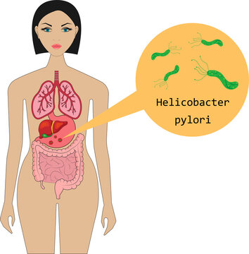 The bacterium Helicobacter pylori in the human body. Anatomy.