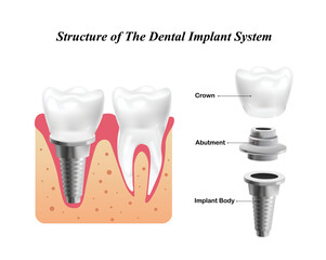 Structure of The Dental Implant System