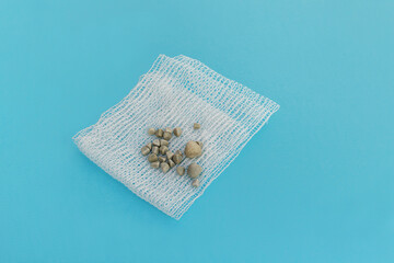 Gallbladder stones close up on a sterile napkin