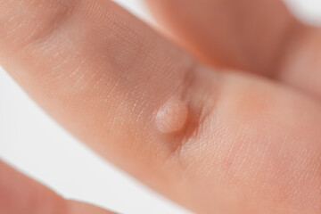 Wart on the finger. Close-up of a wart on a child's finger. The common wart Verruca vulgaris is caused by a type of human papillomavirus, HPV. - obrazy, fototapety, plakaty