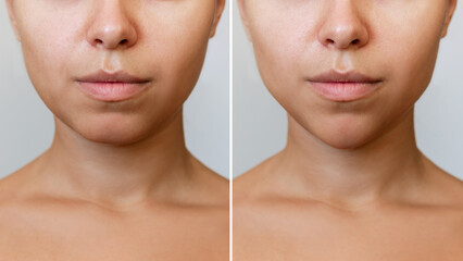 Сhin reduction with fillers. Woman's face with jaws and chin before and after mentoplasty isolated...
