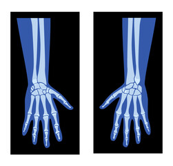 X-Ray Hands with Radius, Ulna Skeleton Human body, Bones adult people roentgen front view. 3D realistic flat blue color concept Vector illustration of medical anatomy isolated on black background