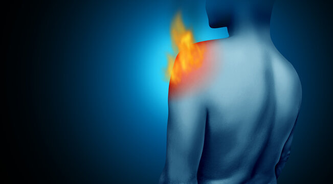 Burning Shoulder Pain and painful rotator cuff joint pain and tendon injury as chronic burning pain inflammation due to an injury of the shoulders