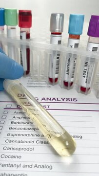 Doctor's hand with urinalysis and blood samples for drug test or alcohol over Medical report. Hand doctor holding a urine and blood tube test for analysis for doping or drugs