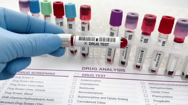 Hand doctor holding a urine and blood tube test for analysis for doping or drugs. Doctor's hand with urinalysis and blood samples for drug test or alcohol over Medical report