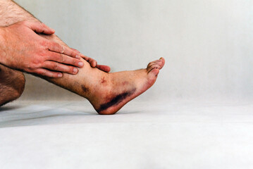 Sprained and swollen ankle.Man hold his sprained ankle at home. Ankle sprain. Injury.White,gray background,copy space.