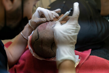 DHI Hair Transplant timelapse Baldness treatment. Hair transplant. HAIR TRANSPLANT - FUE - DHI -...