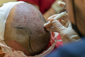 DHI Hair Transplant timelapse Baldness treatment. Hair transplant. HAIR TRANSPLANT - FUE - DHI -...