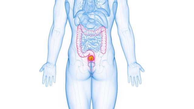 3d rendered medical animation of a neoplastic mass in a man's rectum