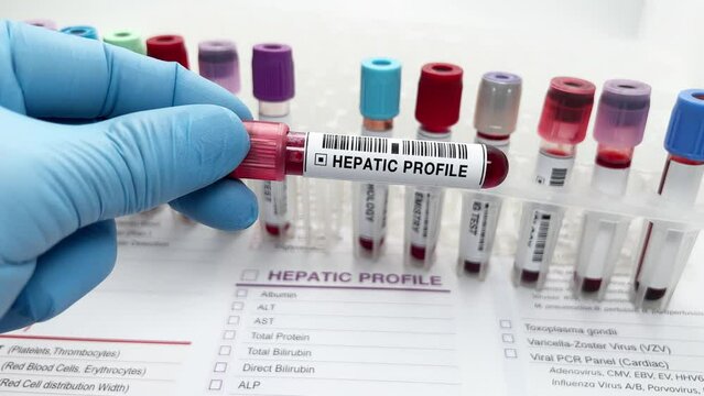 Blood drawn sample from a patient for analysis Liver diseases. Doctor working with blood sample for Hepatic diseases test in the laboratory