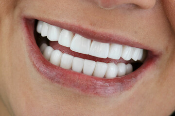 woman teeth before after whitening over