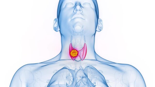 3d rendered medical animation of thyroid cancer in a man's right thyroid lobe