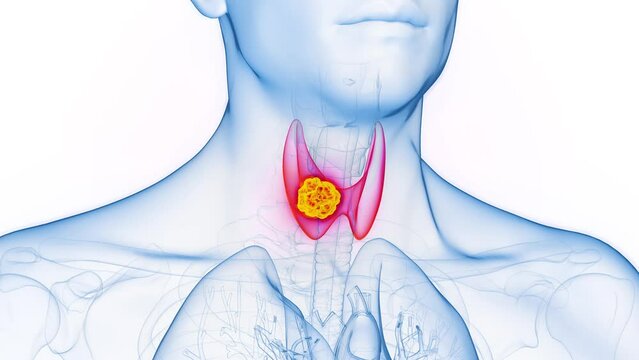 3d rendered medical animation of cancer in a man's thyroid gland