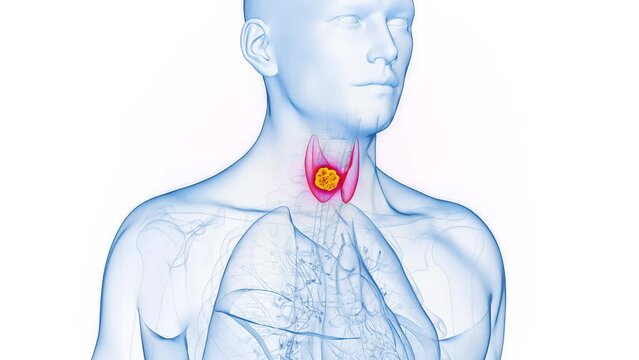 3d rendered medical animation of a malignant tumor in a man's thyroid gland