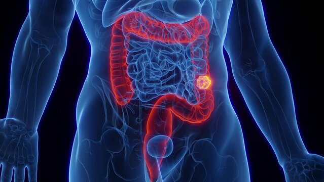 3d rendered medical animation of cancer in a man's descending colon