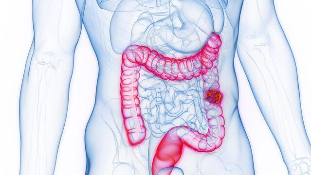 3d rendered medical animation of a neoplasm in a man's descending colon