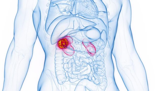 3d rendered medical animation of a malignant tumor in a man's right kidney
