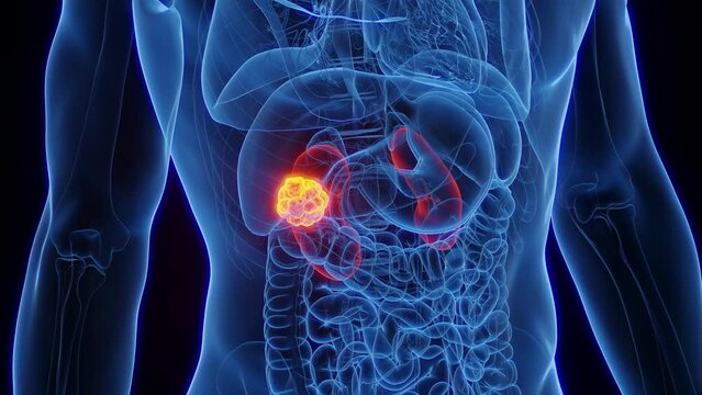 3d rendered medical animation of renal cancer in a male human