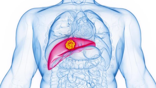 3d rendered medical animation of liver cancer in a human male's liver