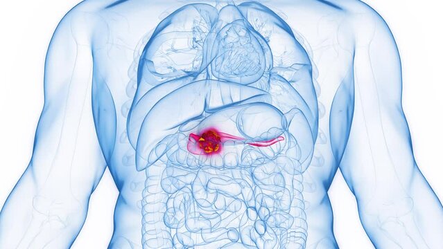 3D rendered Medical Animation of pancreatic cancer in a human male.