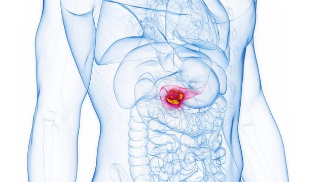 3D rendered medical animation of pancreatic cancer in an adult male human.