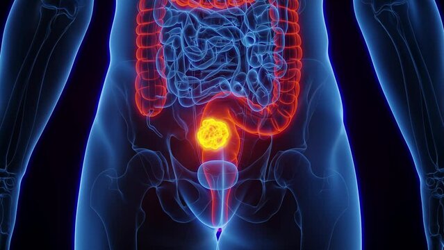 3D rendered medical animation of colorectal cancer in a male human.