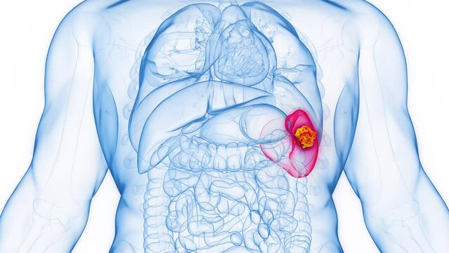 3D rendered medical animation of a cancerous mass in a man's spleen.
