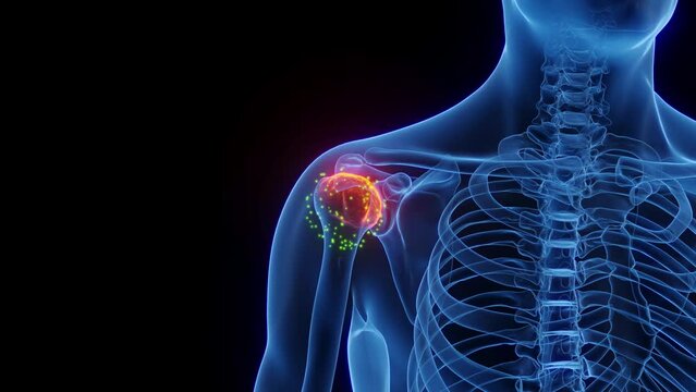 3D rendered Medical Animation of a man's inflamed right shoulder undergoing tissue healing.