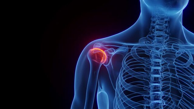 3D rendered Medical Animation of inflammation of a man's right shoulder.