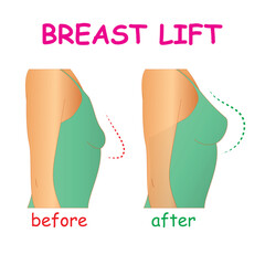 Breast lift, before and after icons