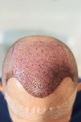 Vertical shot of hair line on male scalp after hair transplant surgery