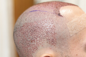 Baldness cure. Treatment for hair loss. Side view of male scalp after hair transplant surgery - obrazy, fototapety, plakaty