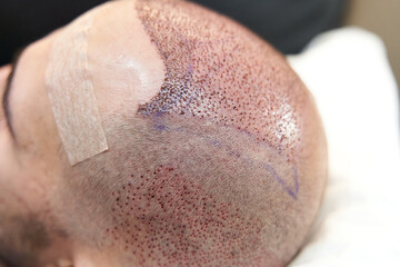 Side view of male head after hair transplant surgery