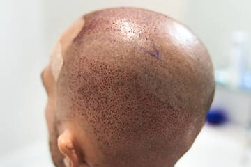 Rear view of balding male head after hair transplant surgery