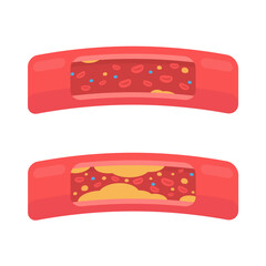 coronary arteries with accumulated fat in the body