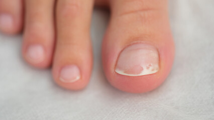 Female foot with damaged nail, fungus disease © megaflopp