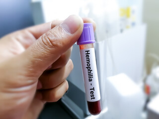 Blood sample for hemophilia test, inherited genetic disorder