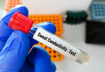 Scientist or biologist hold test tube with sample for sweat conductivity test. diagnosis of cystic fibrosis. - obrazy, fototapety, plakaty