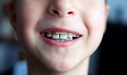 Orthodontist plates on children's teeth. Bite alignment. Orthodontic plate on the upper jaw. Children's tooth.