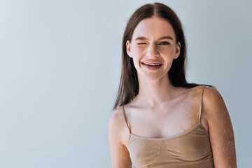 happy young woman with vitiligo and braces winking isolated on grey.