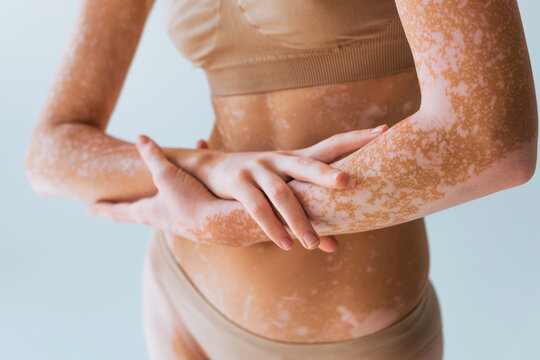 partial view of young woman in lingerie with vitiligo skin posing isolated on grey.