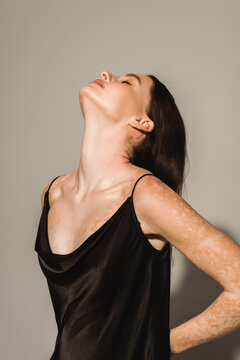 Young model with vitiligo posing in black camisole on grey background.