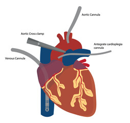 Cannulated Heart for a open chest cardiac surgery. Cardiopumonary bypass system cannula positioned - obrazy, fototapety, plakaty