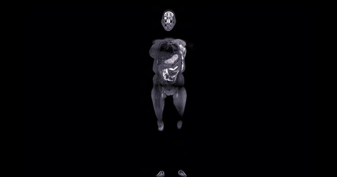 MRI whole body scan Coronal T2 by MRI scanner.