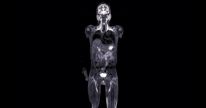 MRI whole body scan Coronal T2 by MRI scanner.