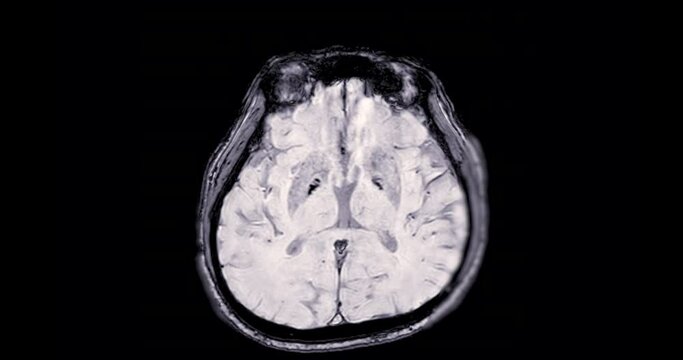 MRI Brain SWI 3D can help doctors look for conditions such as bleeding, swelling, tumors, infections, inflammation, damage from an injury or a stroke diseases.