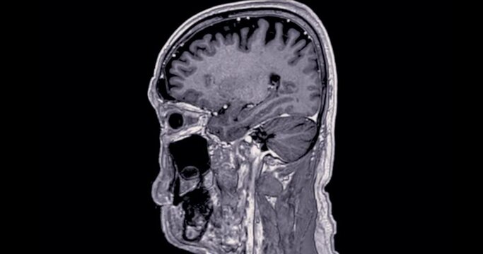 MRI Brain Sagittal T1 3D can help doctors look for conditions such as bleeding, swelling, tumors, infections, inflammation, damage from an injury or a stroke diseases.