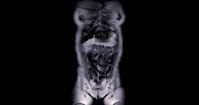 MRI Whole Abdomen Coronal T2 view