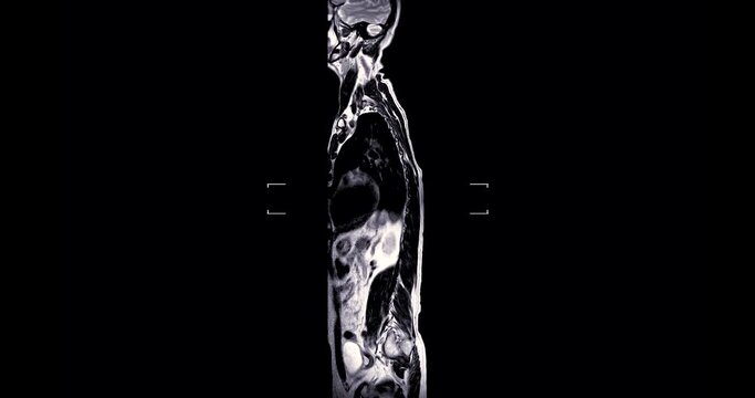 MRI Screening whole spine  sagittal T1 showing  spine compress spinal cord ( Myelopathy )